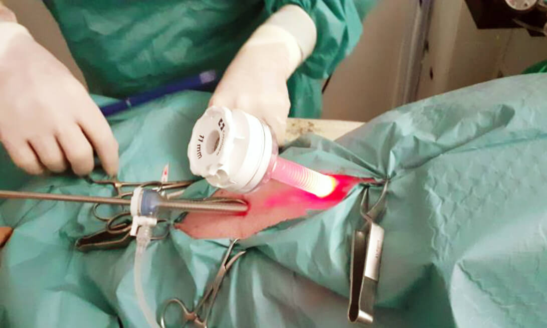 Proceso de laparoscopia